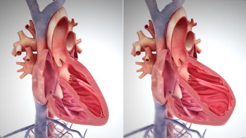 Heart failure illustration Heart failure illustration