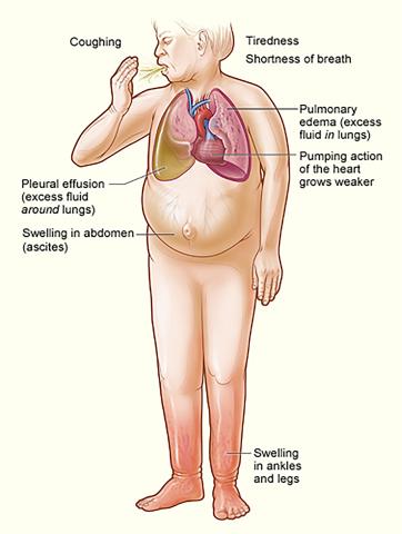 Heart failure symptoms Heart failure symptoms
