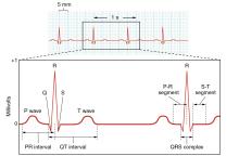 ECG (EKG) labeled diagram